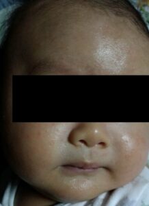 アロベビーミルクローションで乳児湿疹が綺麗に